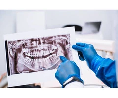 What is the average age to get your wisdom teeth removed?