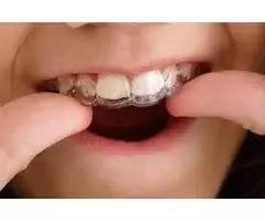 Affordable Invisalign Available Now