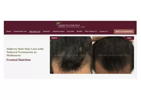 Address Male Hair Loss with Tailored Treatments in Melbourne