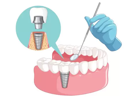 Get the Best Full Arch Implants in Warwick