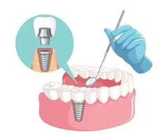 Get the Best Full Arch Implants in Warwick