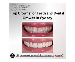 Top Crowns for Teeth and Dental Crowns in Sydney