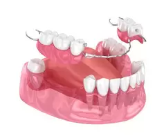Transform Your Smile with Crowns and Bridges