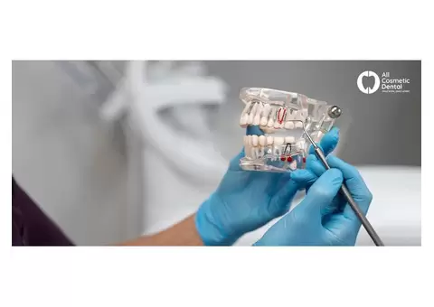 Your Ultimate Resource for Understanding Dental Crowns