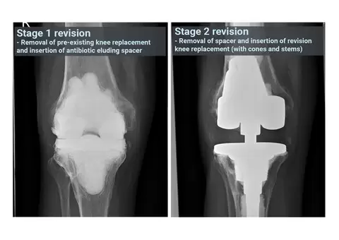 Restoring Functionality With Revision Knee Replacement