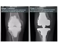 Restoring Functionality With Revision Knee Replacement