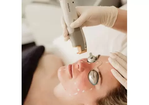 Laser Genesis Treatments – Say Goodbye to Imperfections - 2/2