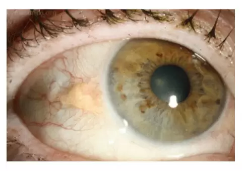 Explore the Best Cornea Eye Specialist Near You