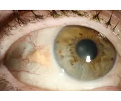 Explore the Best Cornea Eye Specialist Near You