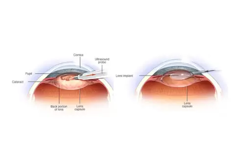 Regain Clarity with Advanced Cataract Removal Solutions