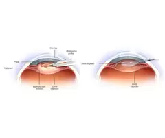 Regain Clarity with Advanced Cataract Removal Solutions