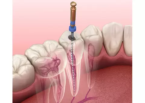 Root Canal in Mitcham to Repair Broken Teeth