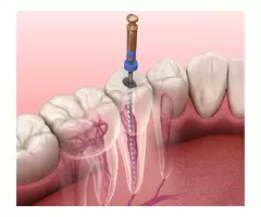 Root Canal in Mitcham to Repair Broken Teeth