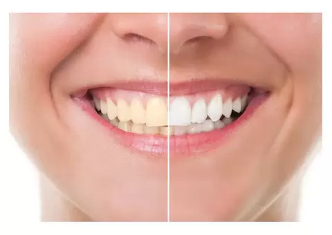 Zoom Teeth Whitening Parramatta
