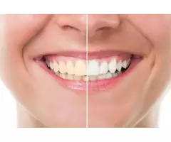 Zoom Teeth Whitening Parramatta