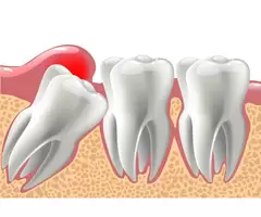 Expert Wisdom Tooth Extraction for a Comfortable Recovery