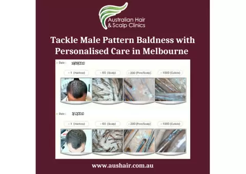Tackle Male Pattern Baldness with Personalised Care in Melbourne