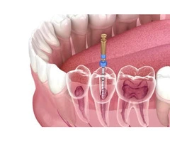 Root Canal Treatment Penrith