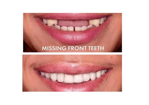 Dentures Treatment in Sydney Reliable Solutions for Missing Teeth