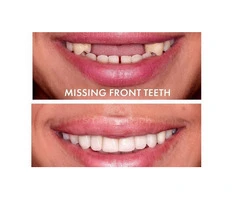 Dentures Treatment in Sydney Reliable Solutions for Missing Teeth