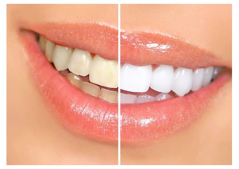 Professional Teeth Whitening in Riverstone