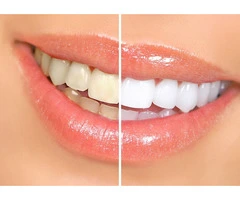 Professional Teeth Whitening in Riverstone