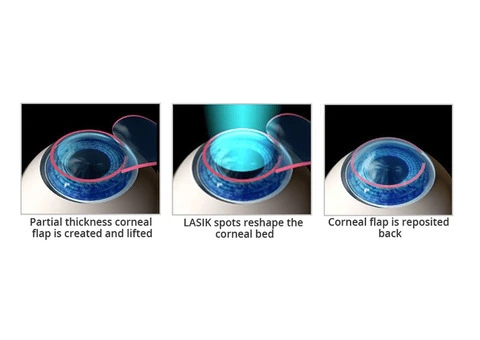 Laser Precision Meets Vision Correction Through LASIK Eye Surgery