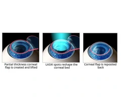 Laser Precision Meets Vision Correction Through LASIK Eye Surgery