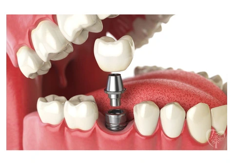 Permanent Tooth Replacement with Dental Implants