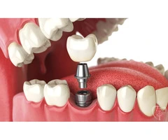Permanent Tooth Replacement with Dental Implants