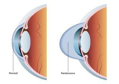 Restore Clarity With Help From an Australian Eye Specialist