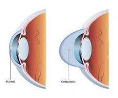 Restore Clarity With Help From an Australian Eye Specialist