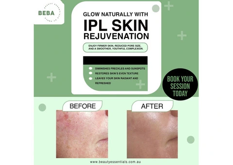 IPL Treatment for Pigmentation in Brisbane: Restore Even Skin Tone