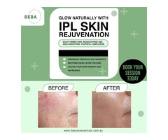 IPL Treatment for Pigmentation in Brisbane: Restore Even Skin Tone