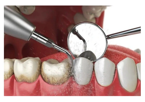 Teeth Cleaning Penrith