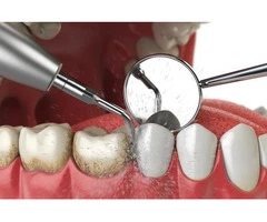 Teeth Cleaning Penrith