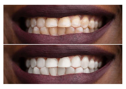 Get a Brighter, Whiter Smile with Expert Teeth Whitening in Whyalla