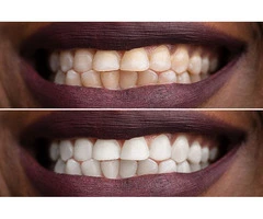 Get a Brighter, Whiter Smile with Expert Teeth Whitening in Whyalla