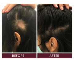 Say Goodbye to Hair Loss with Sydney’s Best Treatments