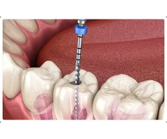 Emergency Root Canal Care in Melbourne