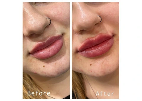 Skin Rejuvenation in Melbourne