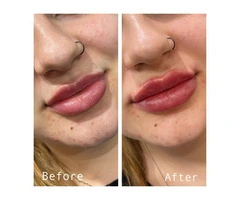 Skin Rejuvenation in Melbourne