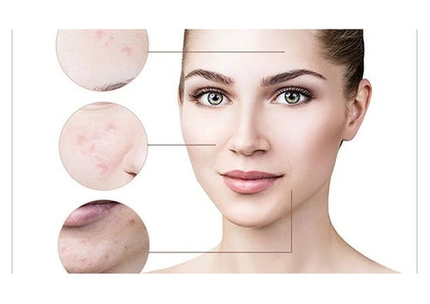 The Ultimate Guide to Acne Treatment with Right Direction Advanced Cosmetics
