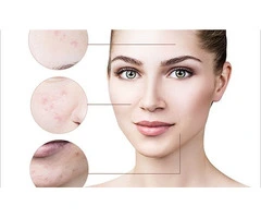 The Ultimate Guide to Acne Treatment with Right Direction Advanced Cosmetics