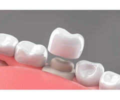 Affordable Tooth Crowns in Victor Harbor