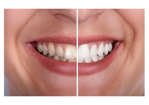 Top Teeth Whitening Dentists in Campbelltown