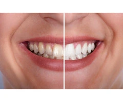 Top Teeth Whitening Dentists in Campbelltown