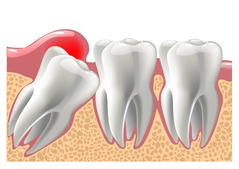 Gentle & Professional Wisdom Tooth Extraction