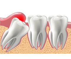 Gentle & Professional Wisdom Tooth Extraction