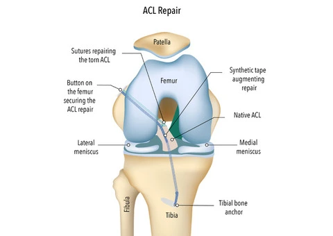 ACL Rupture Repair Helps Restore Knee Stability Safely